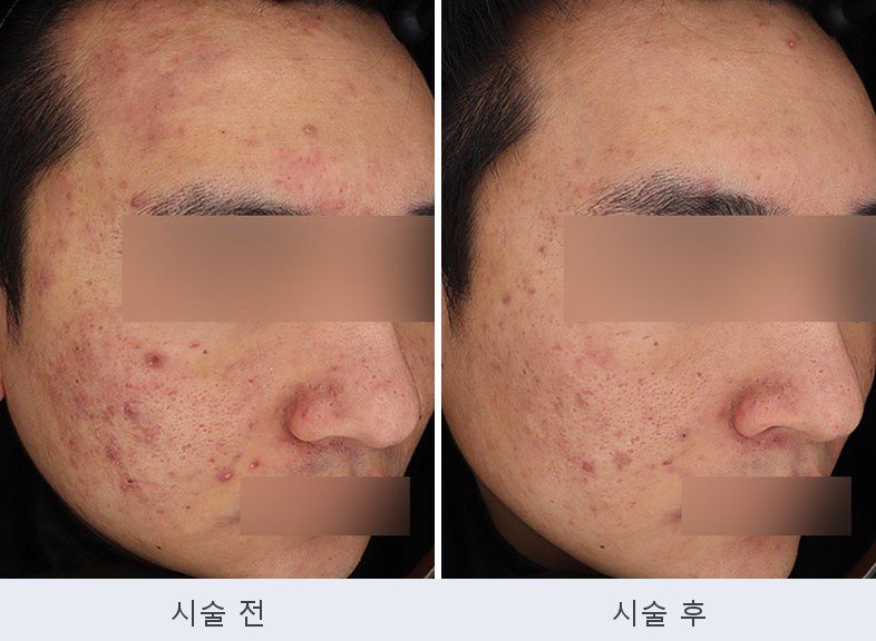 여드름 붉은자국